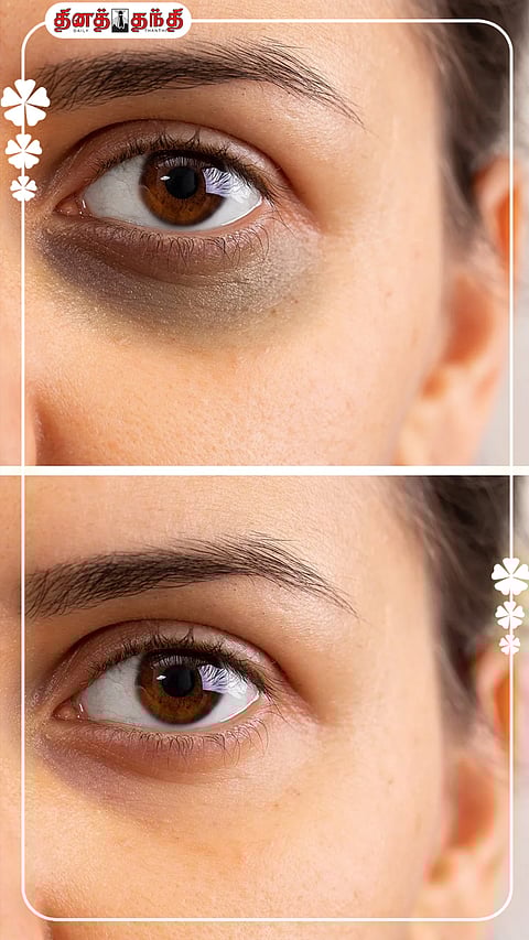 கண்களை சுற்றியுள்ள கருமையைப் போக்க சில வழிமுறைகள்..!
