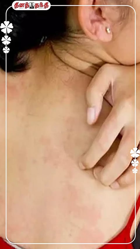 வெயில் காலத்தில் பாடாய்ப்படுத்தும் வியர்க்குருவை தடுப்பதற்கான வழிமுறைகள்..!