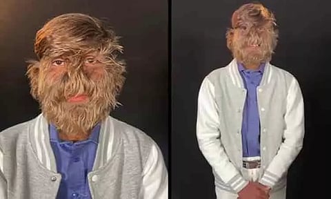 முகத்தில் அதிக முடிகள்..! கின்னஸ் சாதனை படைத்த இந்திய இளைஞர்