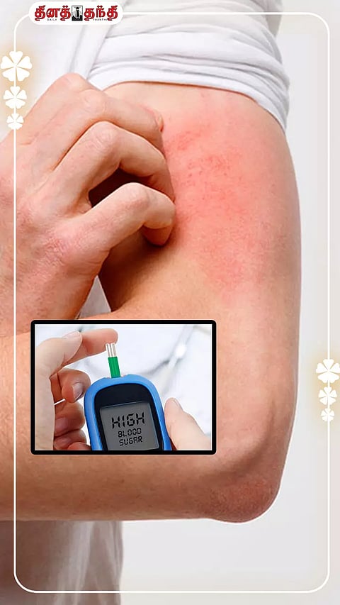 மூன்றில் ஒரு பங்கு சர்க்கரை நோயாளிக்கு அரிப்பு ஏற்படுகிறதா?