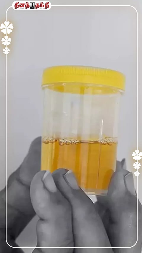 காலையில் சிறுநீர் மஞ்சள் நிறத்தில் செல்கிறதா? காரணம் தெரியுமா?