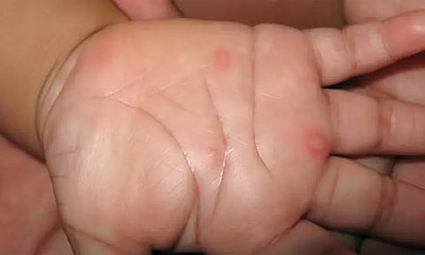 குழந்தைகளை தாக்கும் `தக்காளி காய்ச்சல்' டாக்டர்கள் எச்சரிக்கை