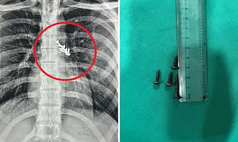 நுரையீரலில் சிக்கிய 7 ஆணிகள்.. 19 வயது இளைஞருக்கு ஷாக்