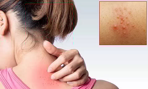 வெயில் காலத்தில் வேதனை தரும் வேர்க்குரு... சர்க்கரை நோயாளிகளே உஷார்