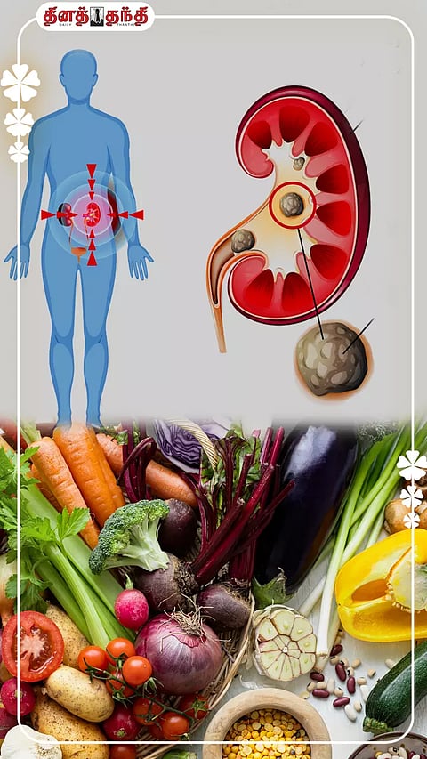 சிறுநீரக கற்கள் உருவாகாமல் தடுப்பதற்கான எளிய வழிமுறைகள்!