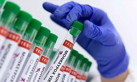 கானாவில் குரங்கம்மை தொற்று பரவல்; 45 பேருக்கு பாதிப்பு உறுதி