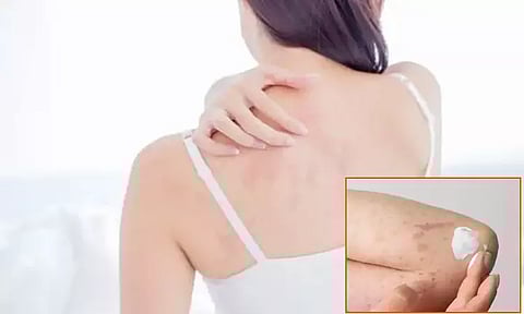 அரிப்பை ஏற்படுத்தி உடலை ரணமாக்கும் கரப்பான் நோய்... தீர்வுகள் என்ன?