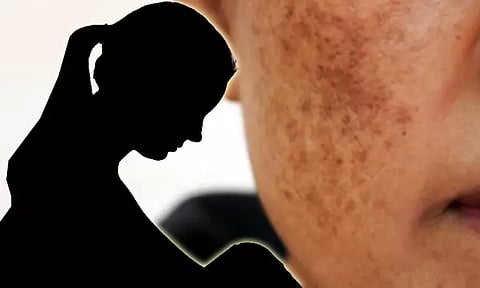 முகத்தில் ஏற்பட்ட கரும்புள்ளி... விரக்தியில் பெண் எடுத்த விபரீத முடிவு