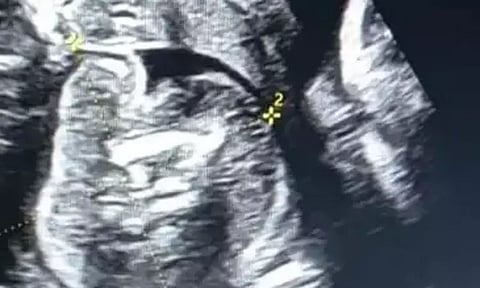 பிறந்த குழந்தையின் வயிற்றில் கரு... பெங்களூருவில் விநோதம்