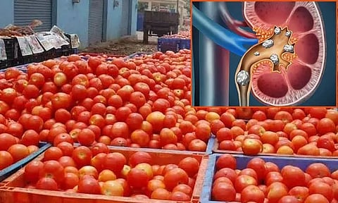 தக்காளி சாப்பிட்டால் கிட்னியில் கல் உருவாகுமா?