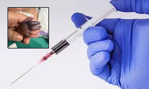 உத்தர பிரதேசம்: மருத்துவமனையில் தவறான ஊசி செலுத்தியதாக குற்றச்சாட்டு - குழந்தையின் கை பறிபோகும் அபாயம்