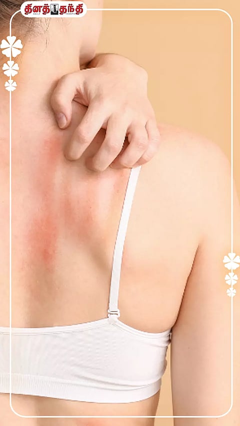 வியர்க்குரு பிரச்சினையா? கவலைய விடுங்க.!!