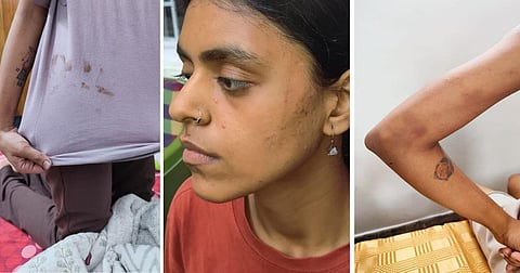 Aranya, a member of a student organisation, shows her injuries and mud-smeared clothes after being allegedly assaulted in police custody.