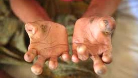 Leprosy