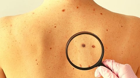 Melanoma Skin Cancer