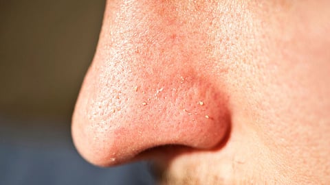 Home Remedies Whiteheads