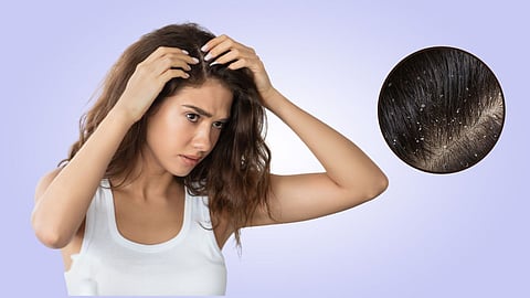 Dandruff Remedies at Home