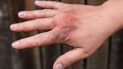 Skin Burn Remedies