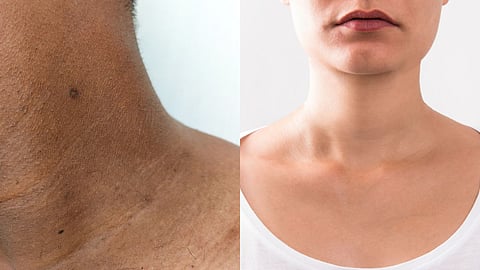 Follow these home remedies to get rid of dark neck