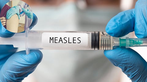 Measles Outbreak in Mumbai