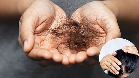 Hair Fall In Women