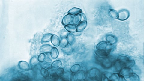 Tinea Infection Treatment