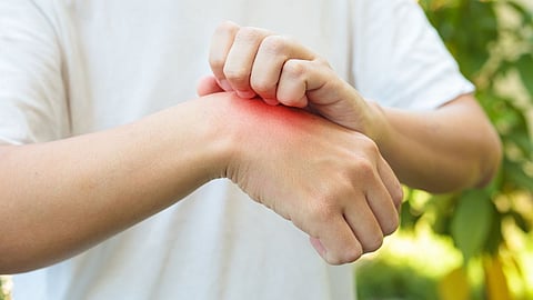 Monsoon Health| Itching