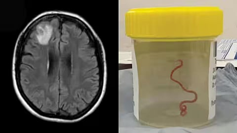 A living roundworm From Snakes And pythons worm found in the brain of woman in Australia.