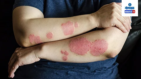 Psoriasis Skin Problem