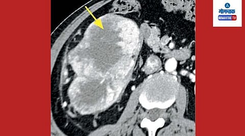 Kidney
