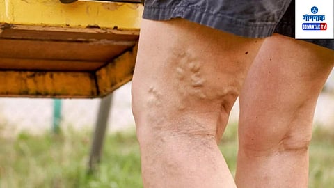 Varicose Veins