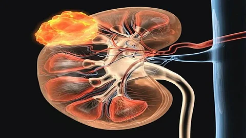 Kidney Bilateral Wilms Tumor: देशात पहिल्यांदाच पार पडली किडनी बायलेटरल विल्म्स ट्यूमर शस्त्रक्रिया; जाणून घ्या काय आहे हा आजार?