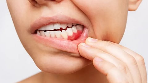 Oral Cancer: तंबाखू न खाणाऱ्यांनाही तोंडाचा कर्करोग, संशोधनातून खुलासा; डॉक्टरांनी सांगितली 'ही' कारणे