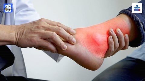 Uric Acid Causes And Prevention