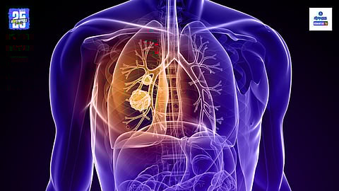 Lung Cancer Symptoms