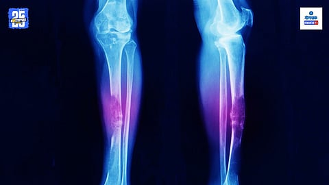 Symptoms Of Bone Cancer: