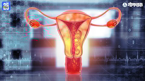 Uterine Cancer