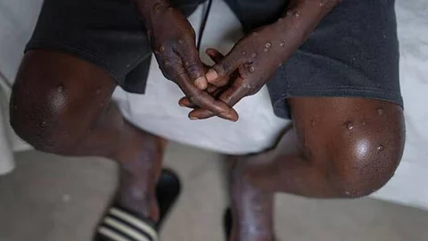The Health Ministry has advised strict isolation and infection control measures after India reported first clade 1b Mpox. Image: AP via livemint.com