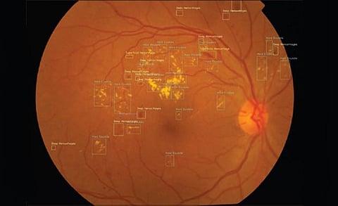 Intel-Powered AI Solution Netra.AI Can Detect Diabetic Vision Loss within Two Minutes