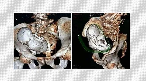 ct scan