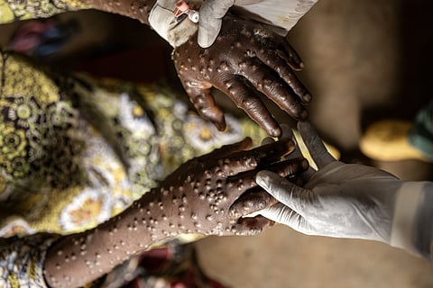 "O mpox não é o próximo covid-19", assegura Centro Europeu de Prevenção e Controlo de Doenças