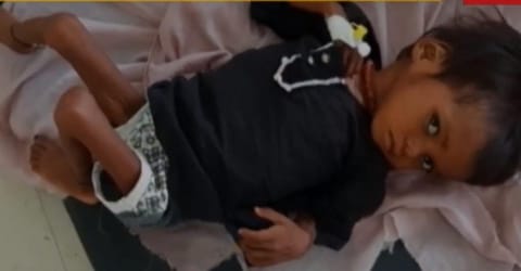 श्योपुर पोषण पुनर्वास केंद्र में भर्ती बच्ची। फोटो: मनीष चंद्र मिश्रा