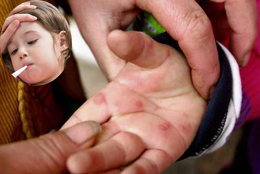 भारत में फैल रहा टोमैटो फ्लू, जानिए क्या है लक्षण और इलाज?