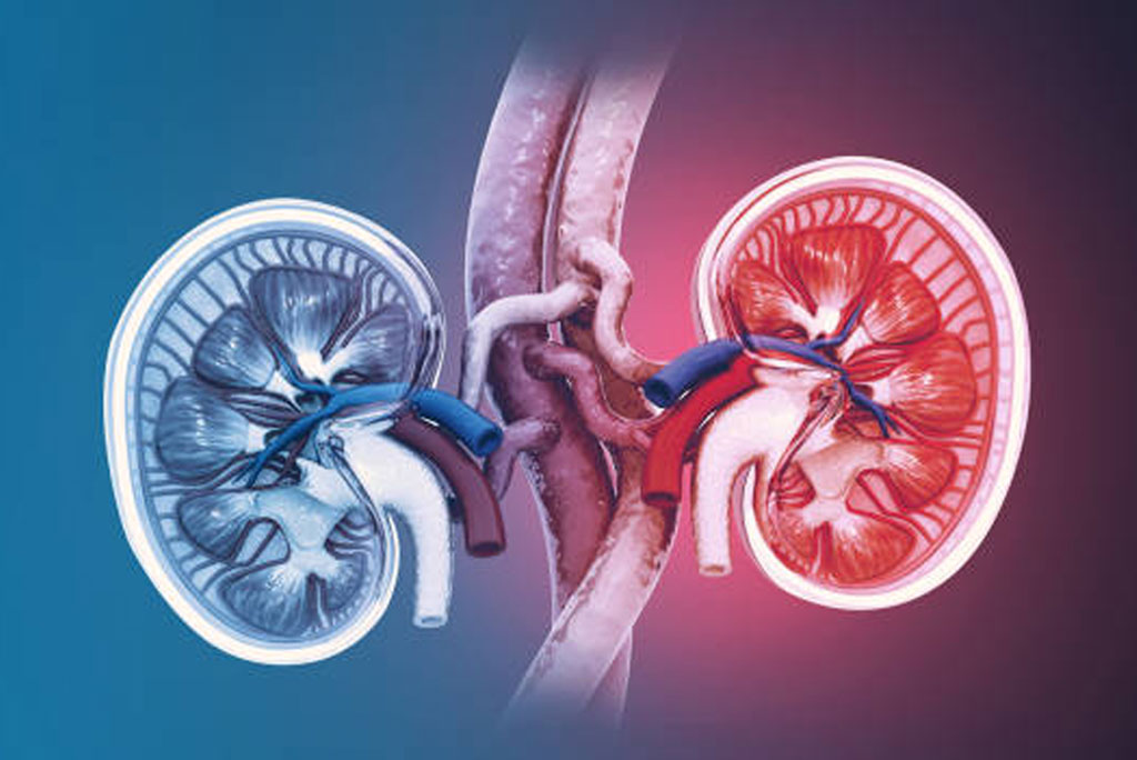 किडनी रोग के प्रमुख कारणों में मधुमेह, उच्च रक्तचाप, मोटापा, धूम्रपान और अस्वस्थ जीवनशैली शामिल हैं।