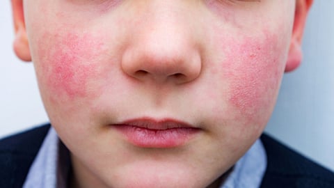 Representative Image for Common parvovirus B19