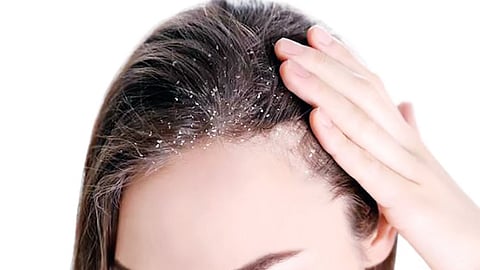 Dandruff are more common than ever, affecting millions across India.
