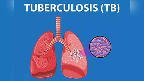 Representative Image of Tuberculosis