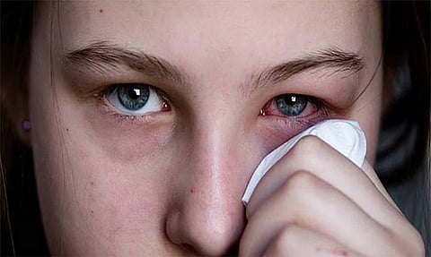 Representative image