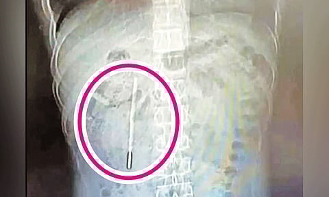 Thermometer removed from man’s stomach after 20 years in China