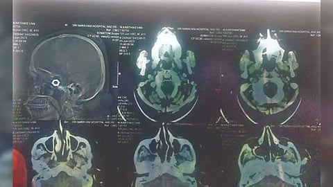 X-rays showing the nut lodged in the driver’s head